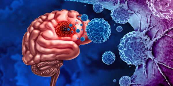 Le Mutazioni IDH nei Gliomi: Implicazioni Molecolari, Cellulari, Diagnostiche e Cliniche